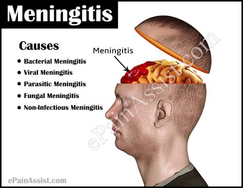meningitis disease images